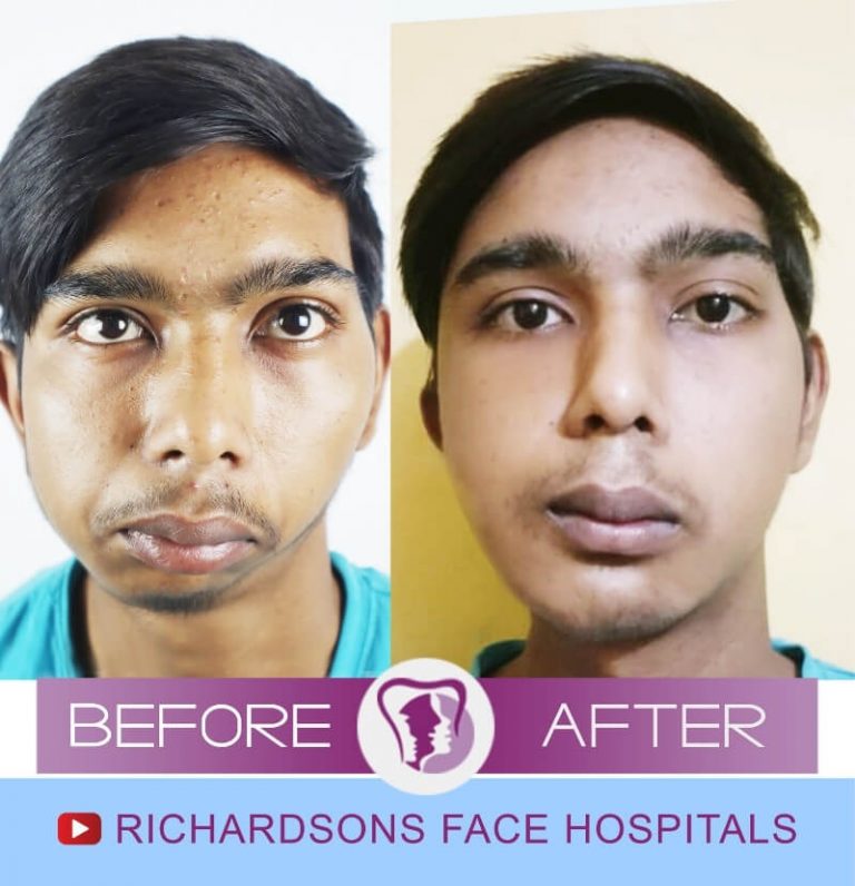 5 Things You Need to Know About Open Joint TMJ Surgery in India