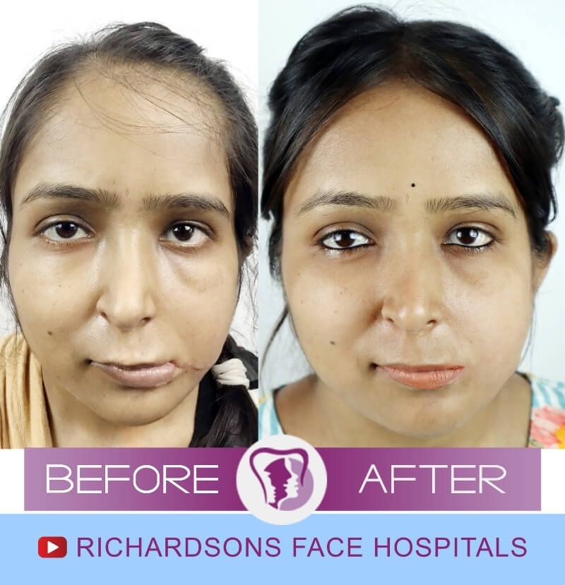 Aahuti Raj Lip Reduction Surgery