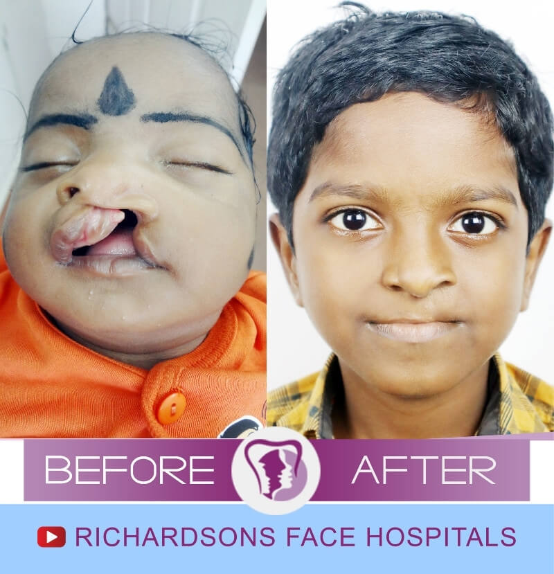 Adharsh Cleft Lip Palate Surgery