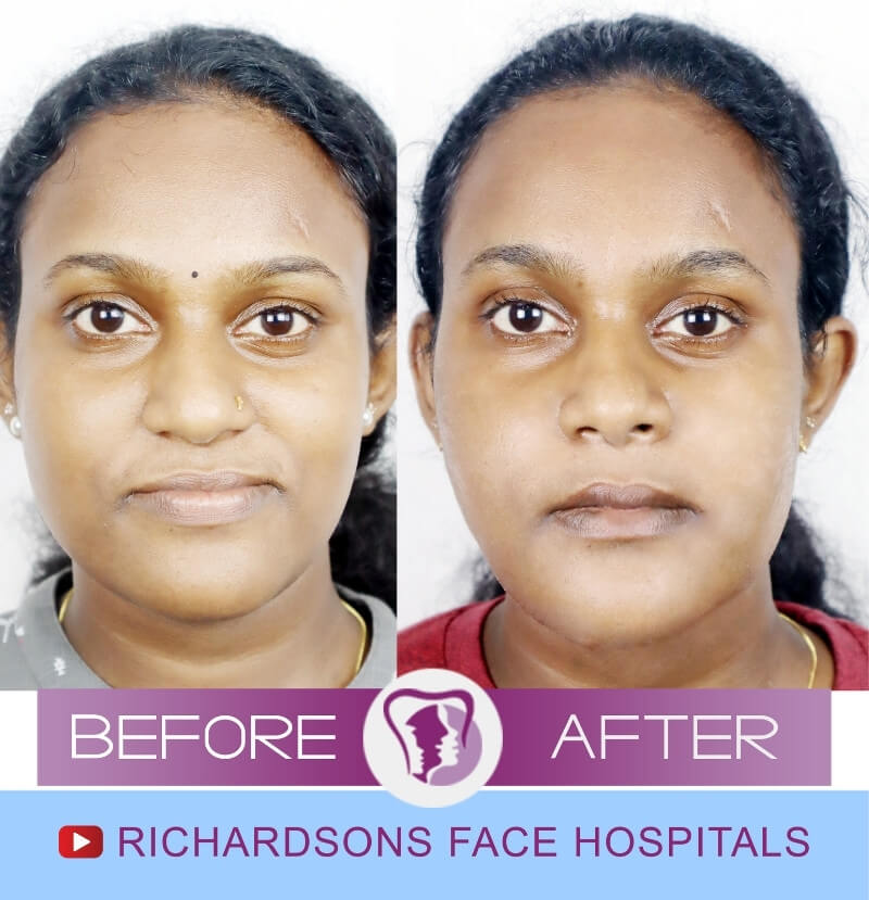 Aiswarya Anil Jaw Surgery