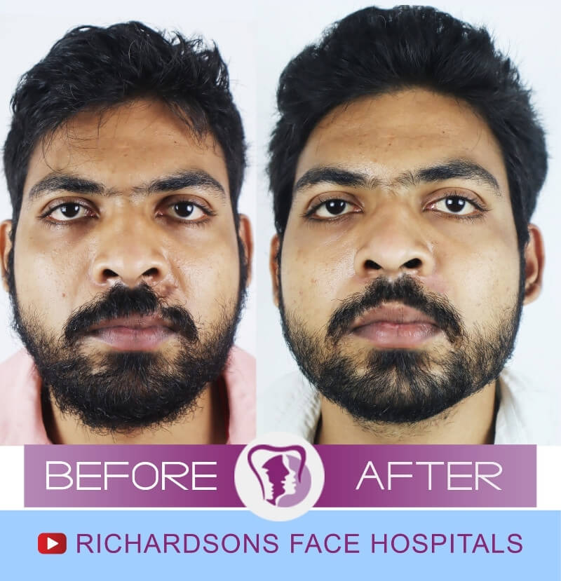 Anish Raj Scar Surgery