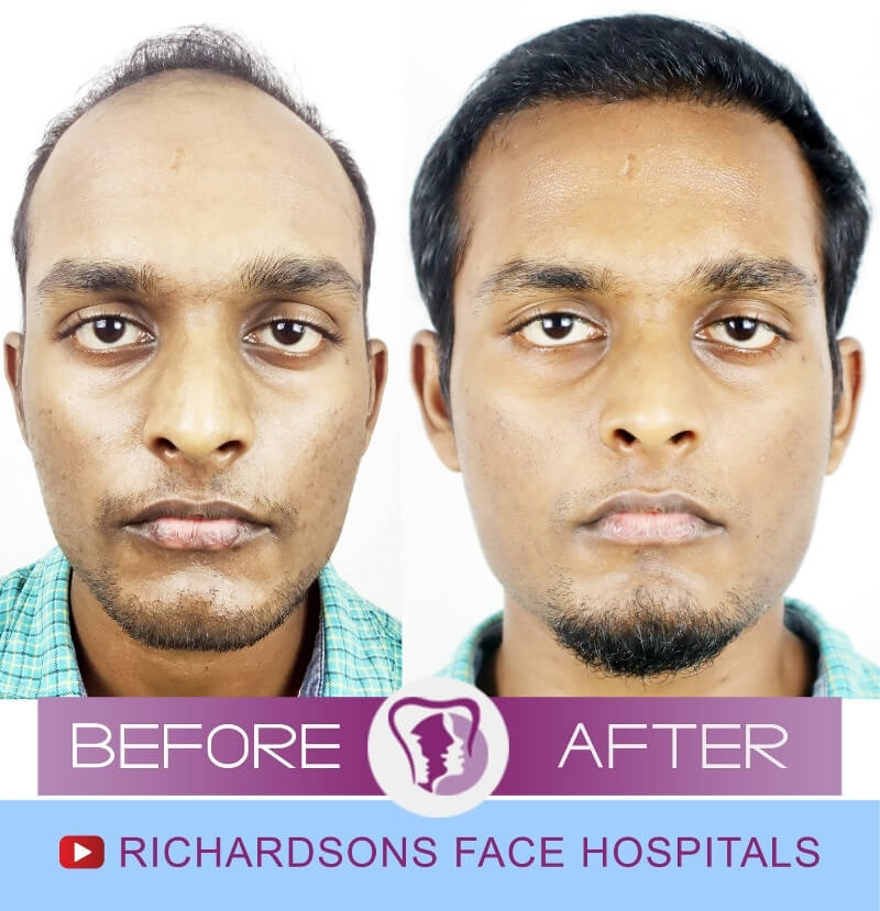 Arun Kumar Hair Transplant Surgery