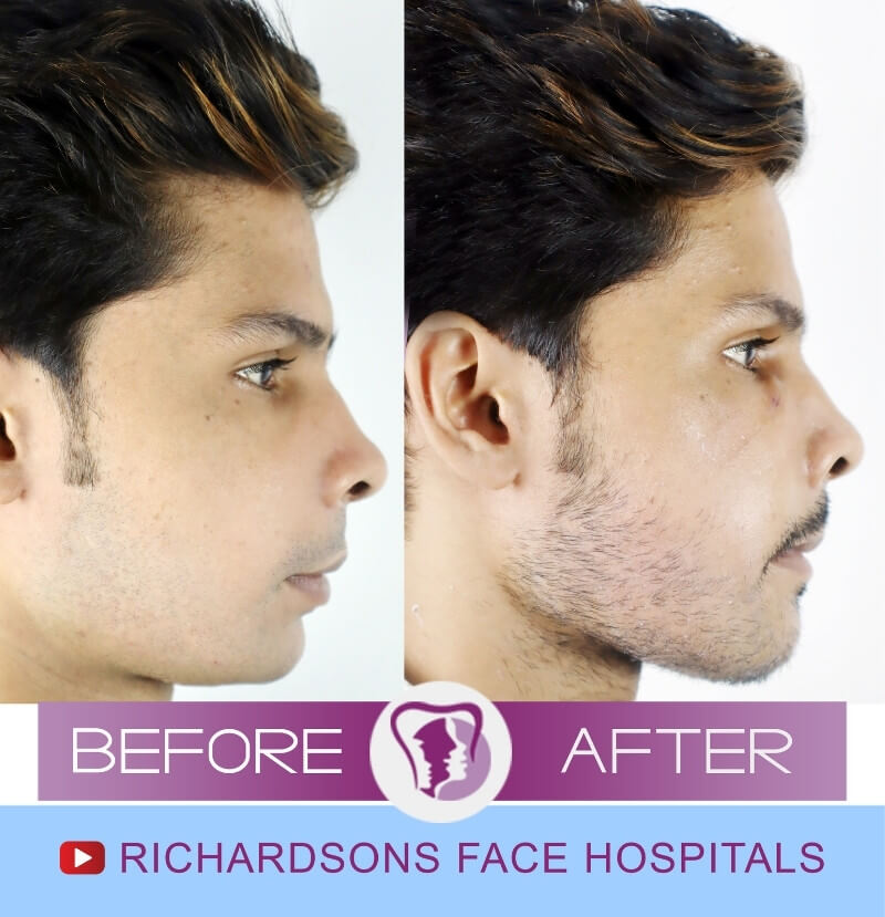 Chin Correction Surgery Faizen Ansari