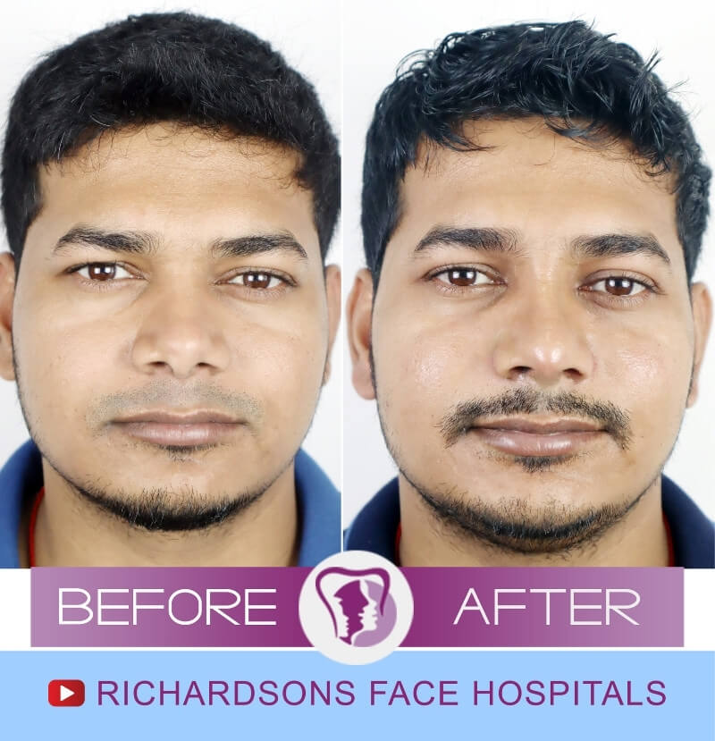 Deepak Rhinoplasty Surgery