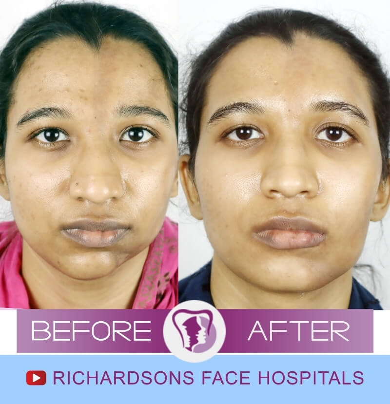 Facial Asymmetry Surgery Asma