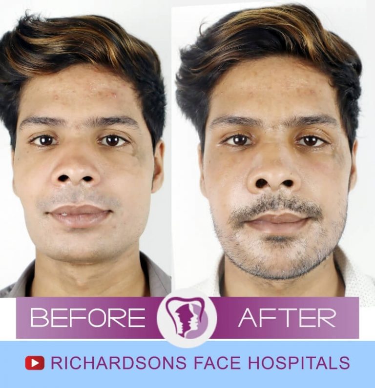 4 Things To Know Before Getting Cheek Fillers – Richardson's Plastic ...