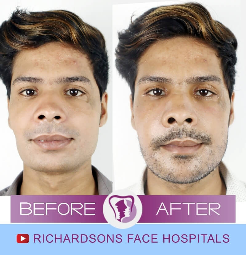 Faizen Ansari Chin Correction Surgery