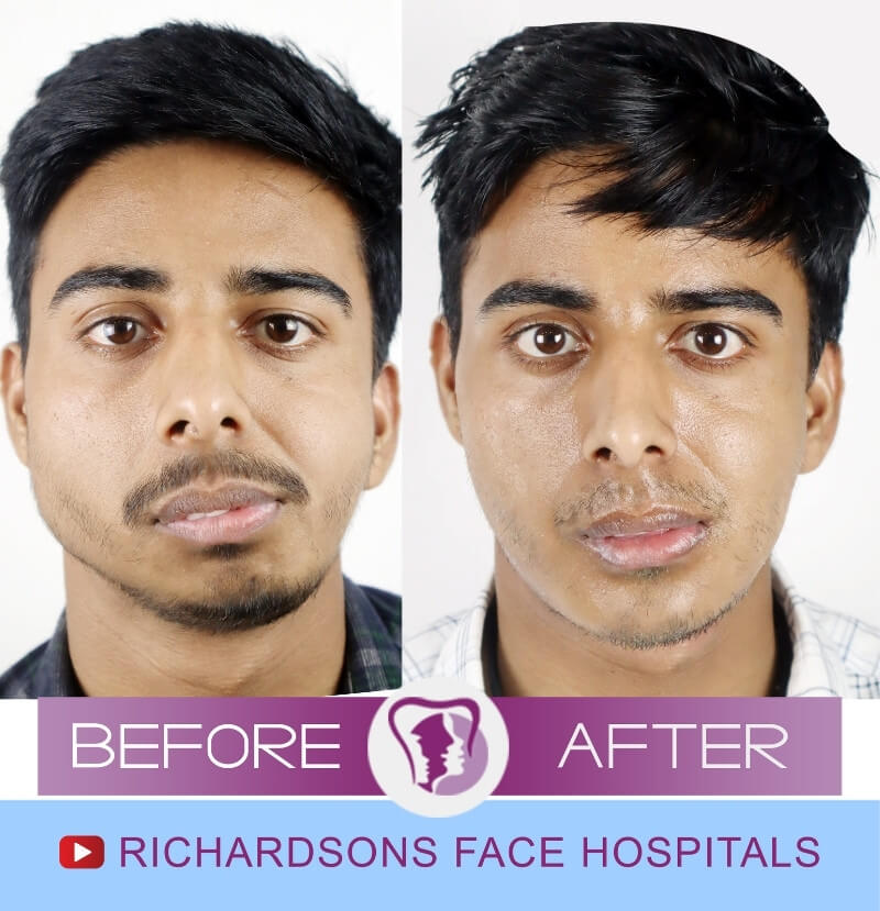 Genioplasty Surgery Surya Pradap