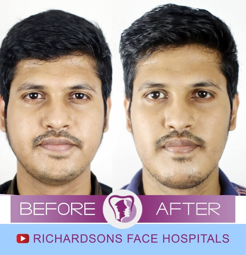 Gorthi Genioplasty Surgery