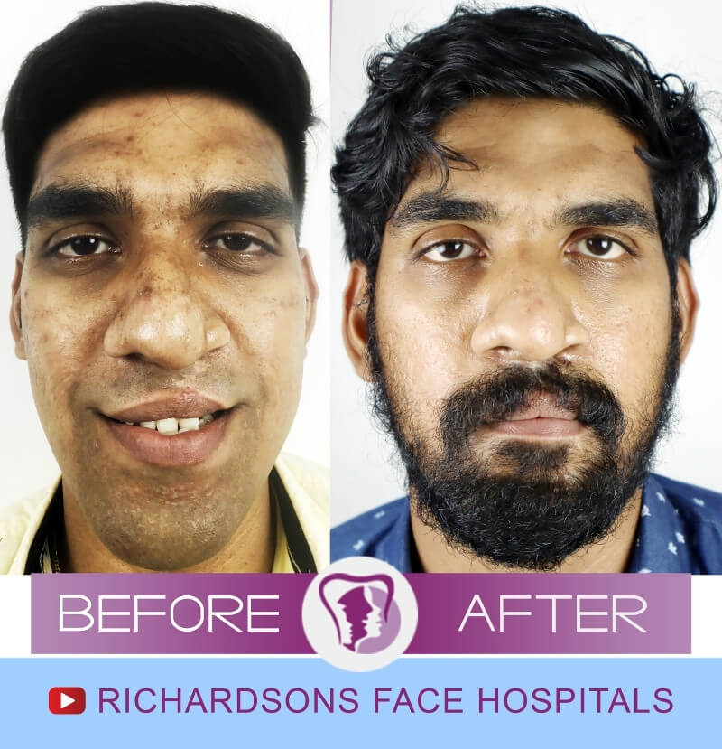 Hari Krishnan Face Makeover Surgery