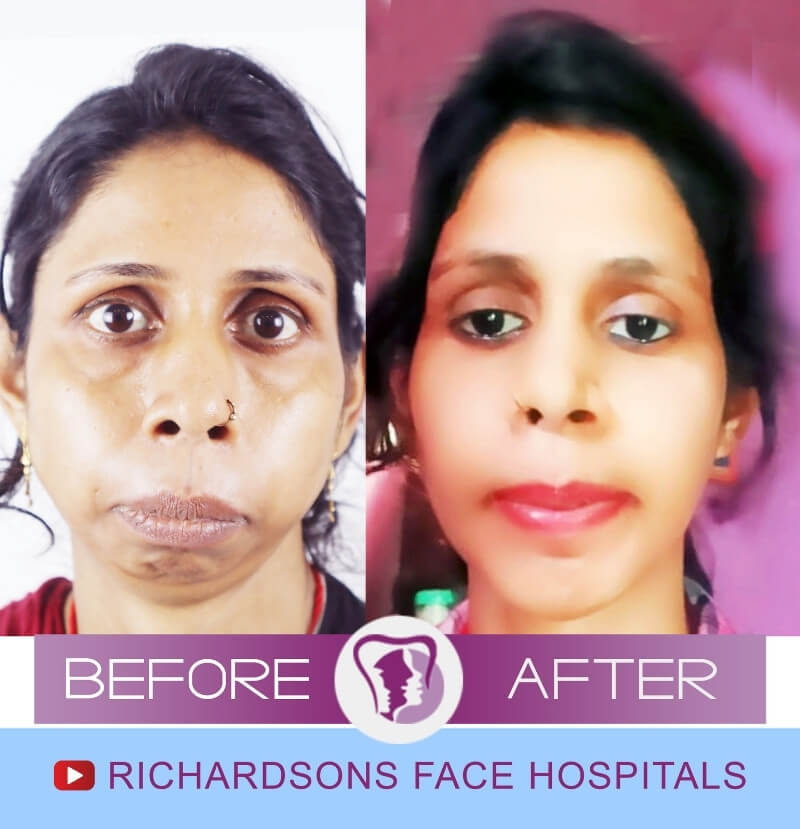 Hema Priya Bijaw Surgery