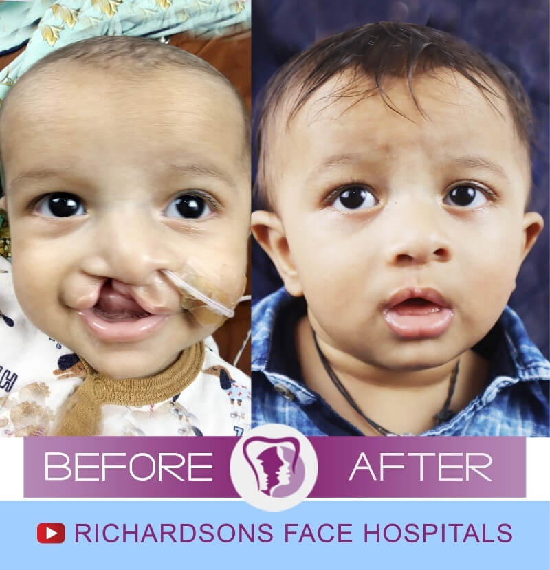 Hussamuddin Cleft Lip Palate Surgery