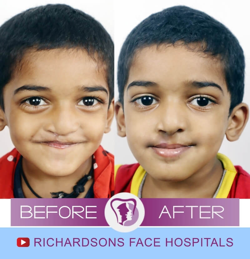 Karthick Lip Revision Surgery