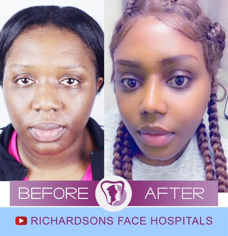 Kerion Face Makeover Surgery