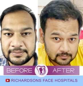 Lalith Kumar Hair Transplant Surgery