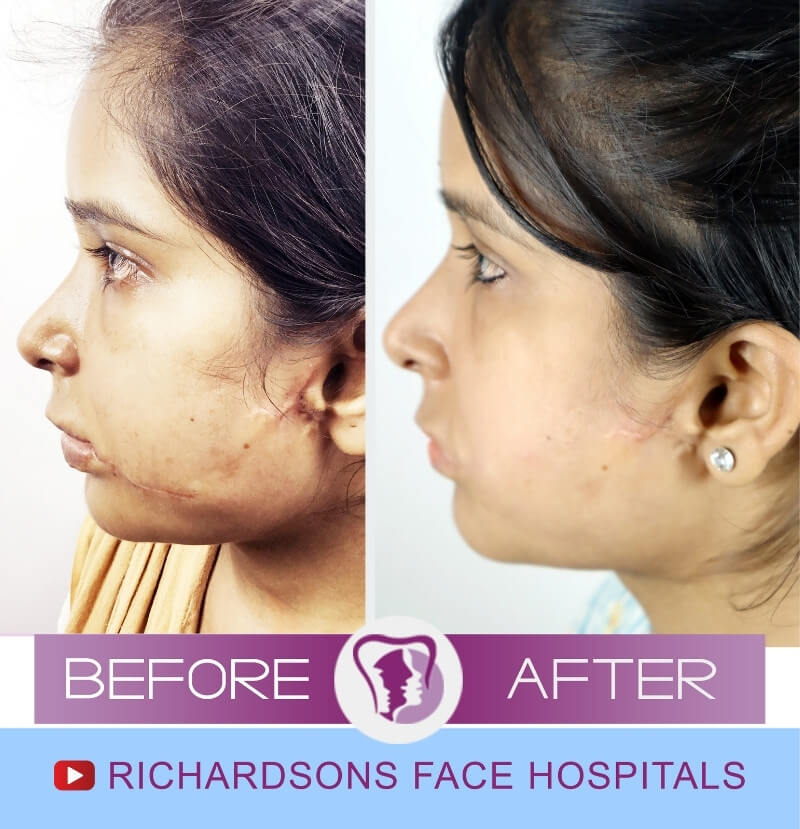 Lip Reduction Surgery Aahuti Raj