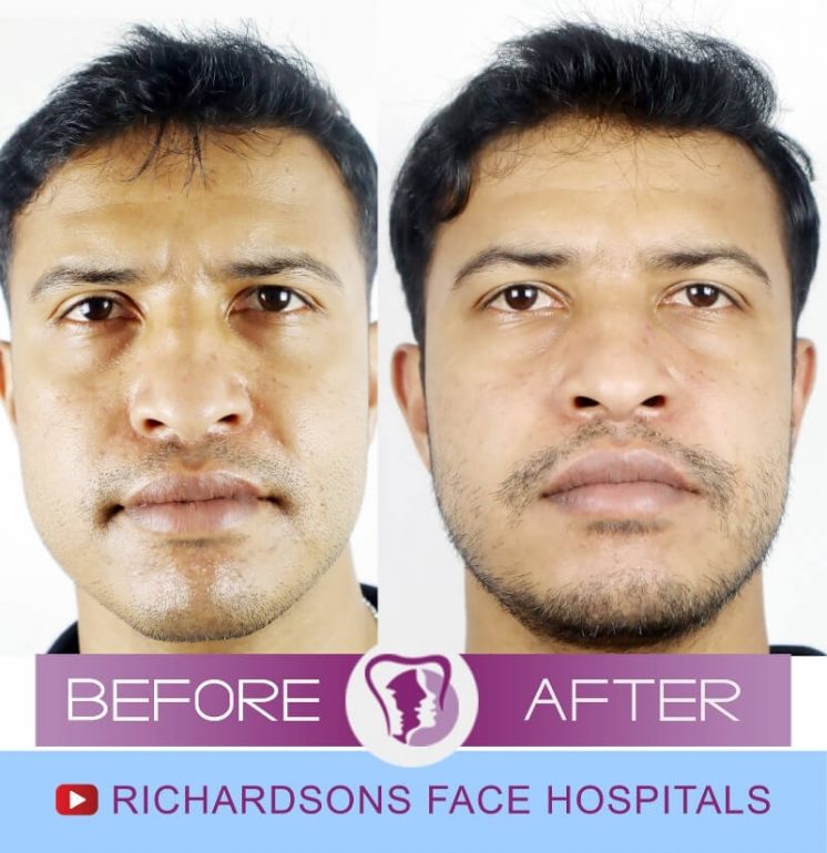 Everything You Need To Know About Corner Lip Lift Surgery Richardson