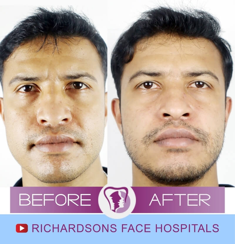 subnasal lip lift treatment cost Archives - Richardson's Plastic Surgery  Hospitals