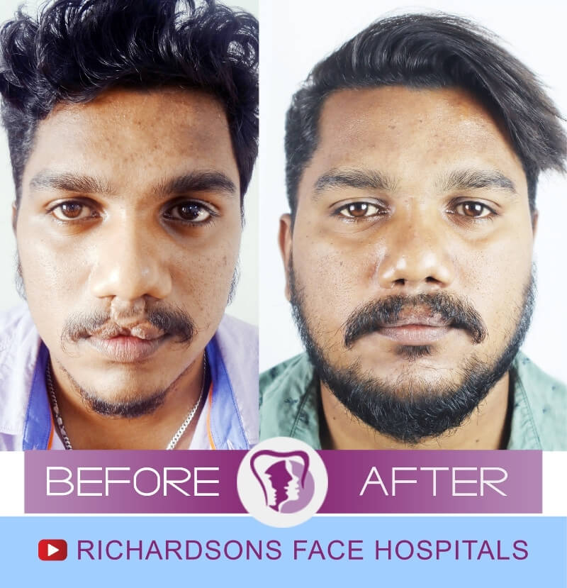 Nishanth Raj Lip Reduction Surgery