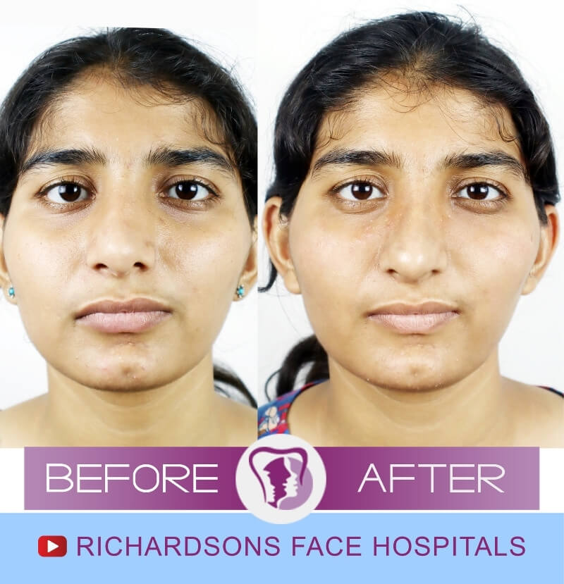 Niveditha Rhinoplasty Surgery