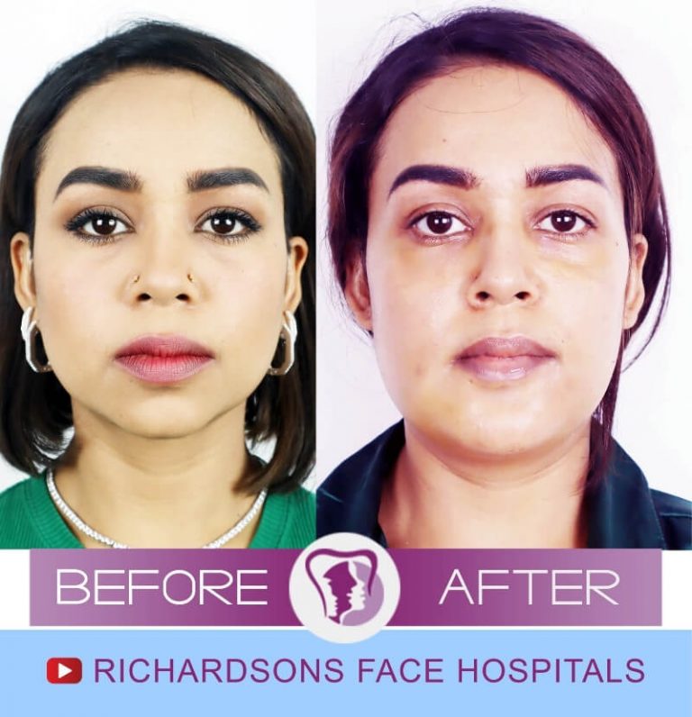 Everything You Need to Know About Jaw Filler Treatment in India