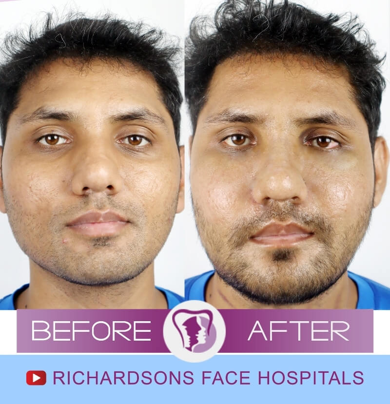 Pankaj Facial Asymmetry Surgery