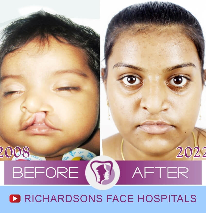 Prathanisha Cleft Lip Palate Surgery