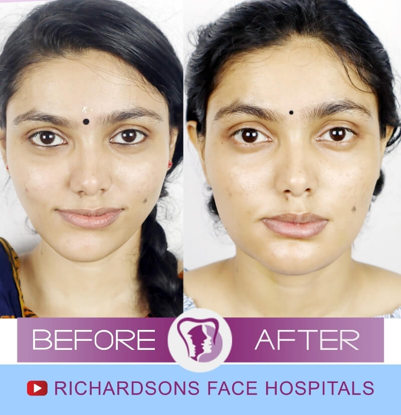 Sree Lakshmi Face Makeover Surgery