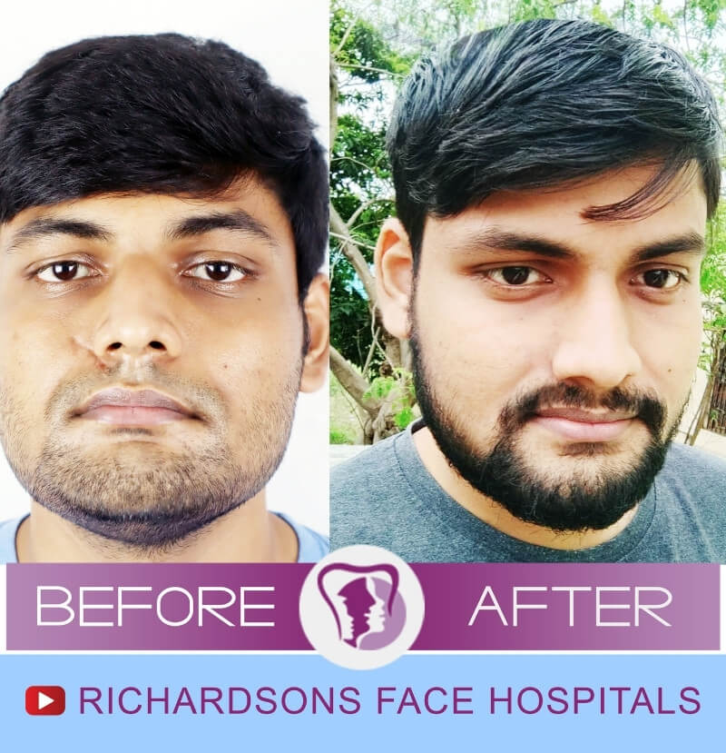 Vijayaprabhu Scar Surgery