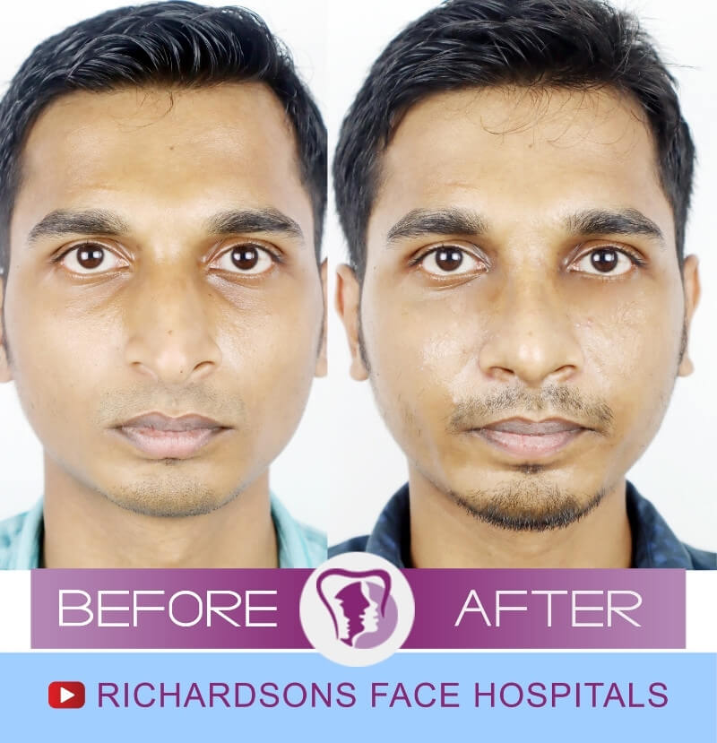 Vishnu Rhinoplasty Surgery