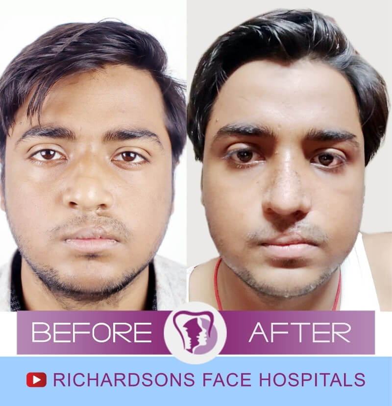 Abinaw Raj Rhinoplasty Surgery