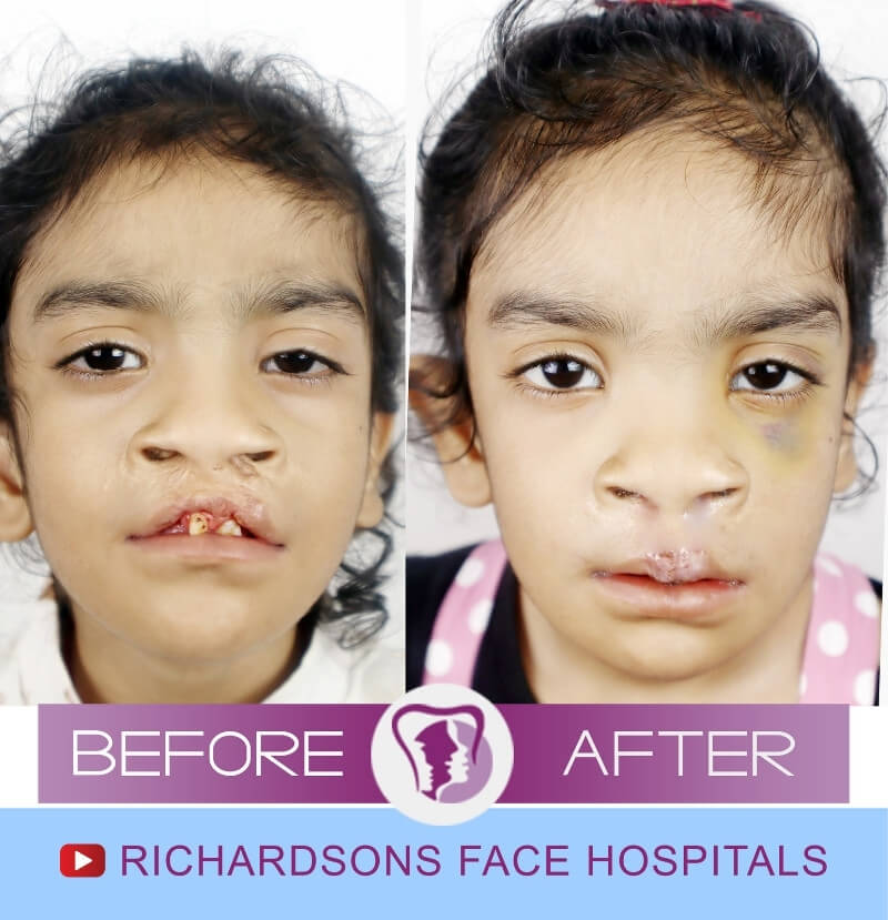 Aliya Lip Reduction Surgery