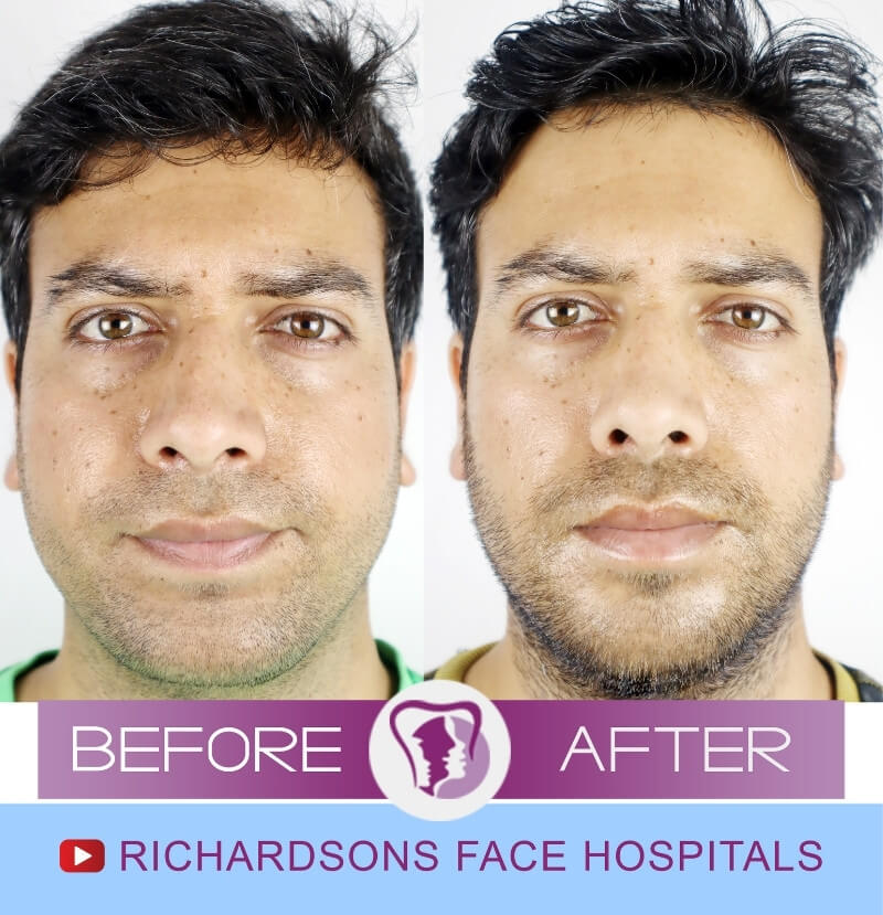 Amar Singh Genioplasty Surgery