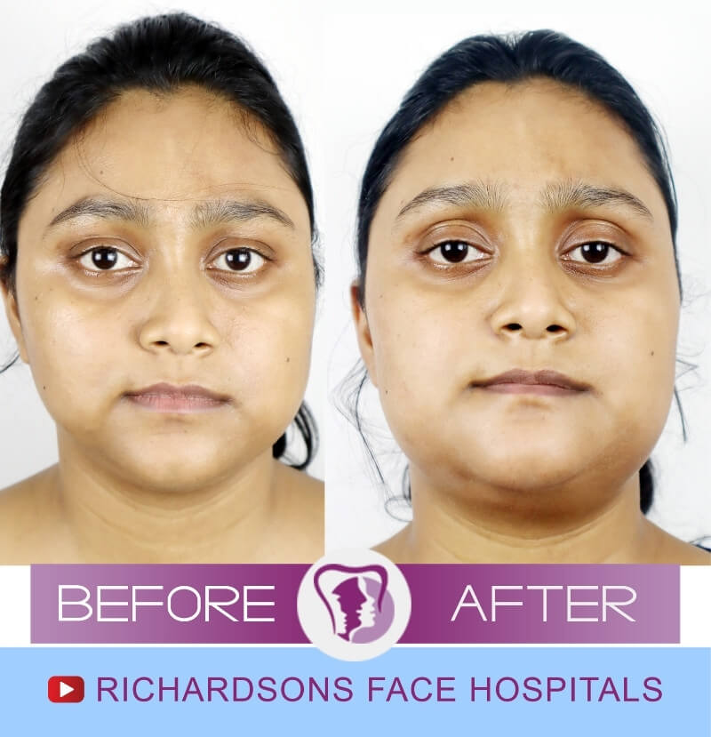 Anju Khatun Facial Asymmetry Surgery