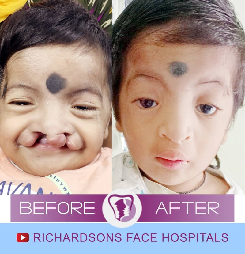 Badavath Cleft Lip Palate Surgery