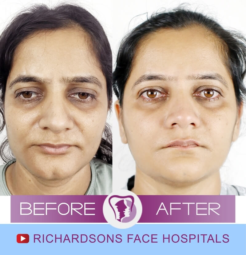 Bharti Genioplasty Surgery