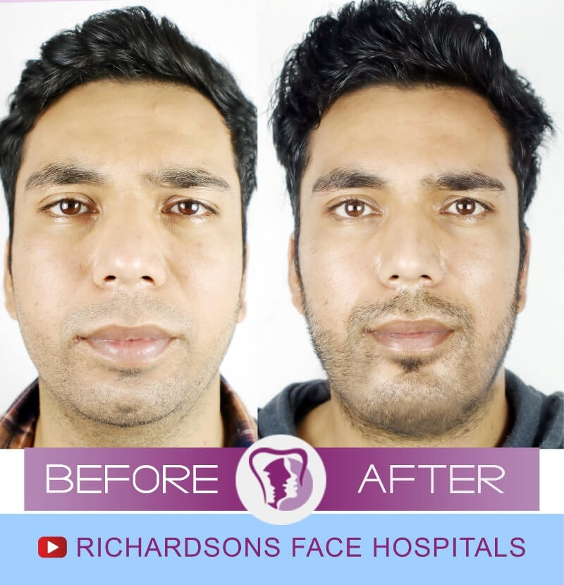 Deepak Sharma Genioplasty Surgery