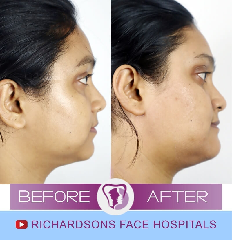 Facial Asymmetry Surgery Anju Khatun