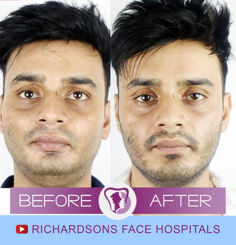 Genioplasty Surgery Pranay Kumar