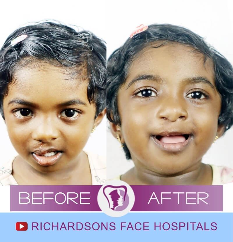 Harthika Lip Reduction Surgery