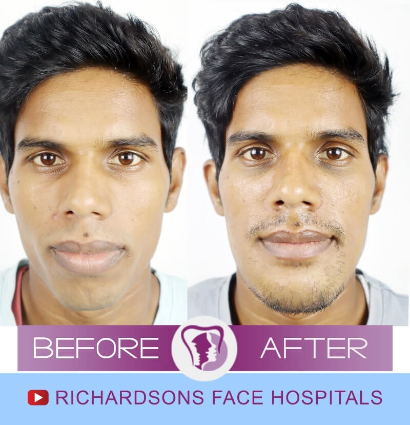 Indrjeet Jaw Surgery