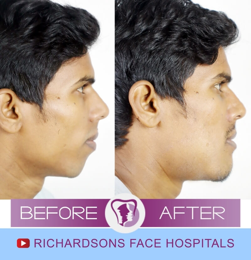 Jaw Surgery Indrjeet