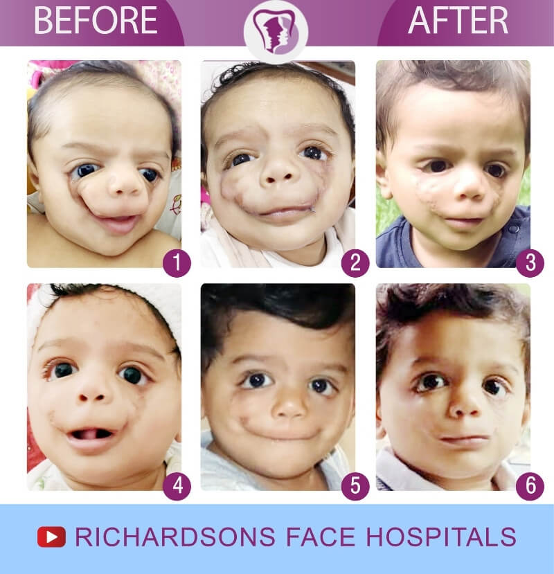 Joshua Facial Cleft Lip Palate Surgery