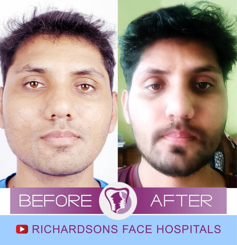 Pankaj Pal Facial Asymmetry Surgery