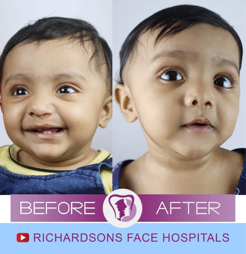Prithika Cleft Lip Palate Surgery