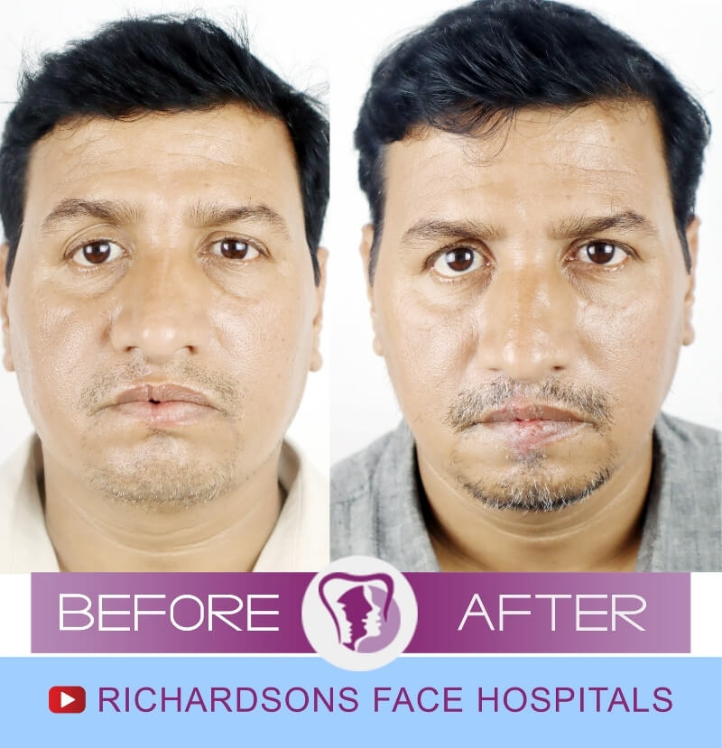 Ranjeet Kumar Lip Reduction Surgery