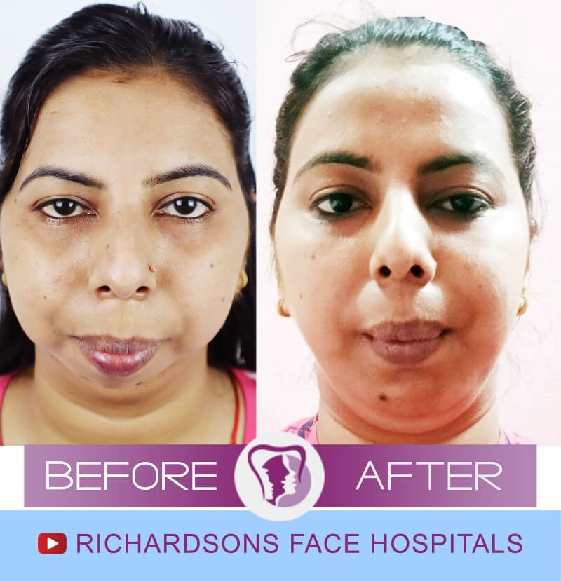 Sangeetha Kumari Genioplasty Surgery