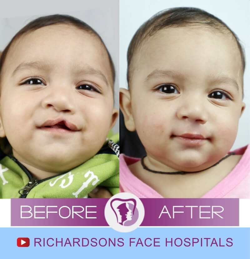 Shauryaveer Sinh Cleft Lip Palate Surgery