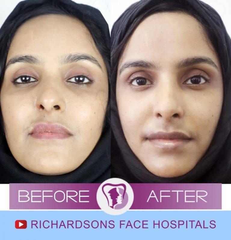 All That You Must Know About Lip Lift Surgeries Richardson's Plastic