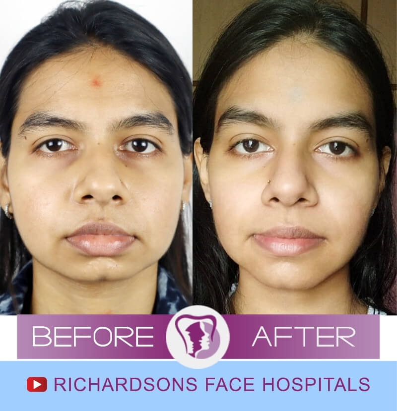 Anusha Genioplasty Surgery